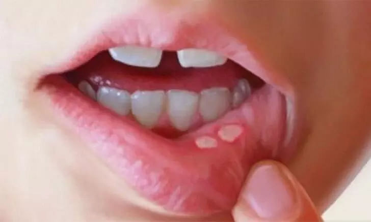 What is Mouth Ulcer? Causes, symptoms, and home remedies - Sentinelassam